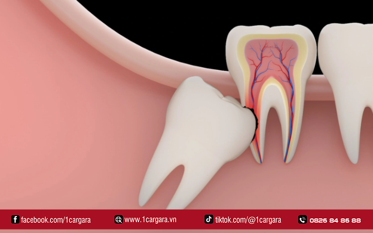 Chi phí nhổ răng khôn thay đổi theo thế mọc và công nghệ