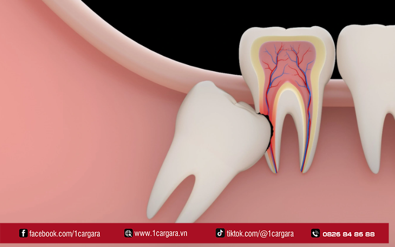 Chi phí nhổ răng khôn thay đổi theo thế mọc và công nghệ