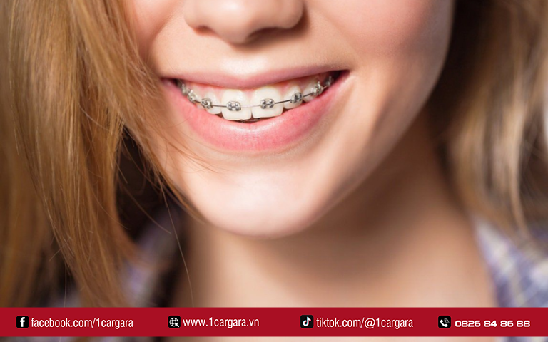 Chi phí niềng răng hiện nay phụ thuộc phương pháp và tình trạng răng