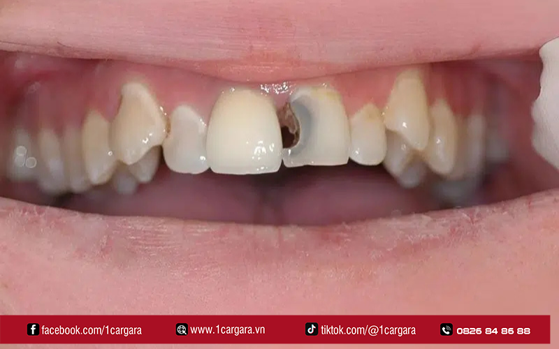 Giá trám răng sứ, GIC và composite chênh lệch tùy độ bền